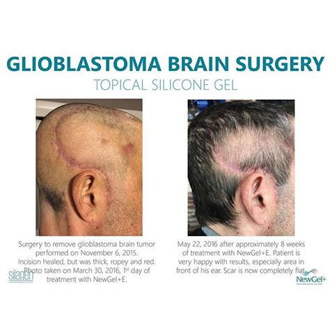 For the first week following surgery, you will be prescribed steroids to reduce inflammation in the brain and some patients also require anti-epilepsy medications. . Healed from glioblastoma